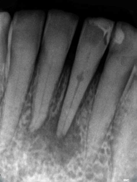 Teeth Treat Internal Tooth Whitening