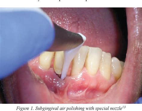 PDF Efficacy Of Subgingival Air Polishing In Patients With Aggressive