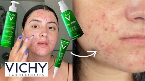Acne Prone Skin Routine Review With Vichy Normaderm Youtube