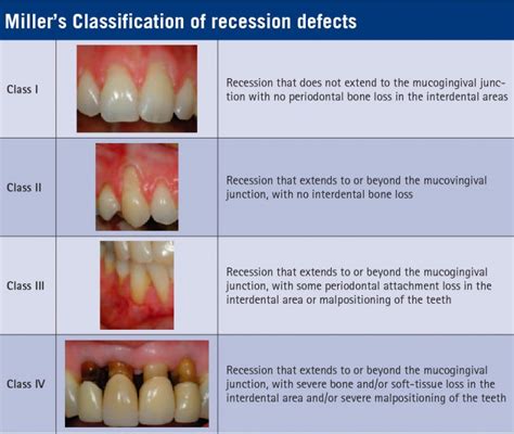 Gum Recession Dentist Cambridge