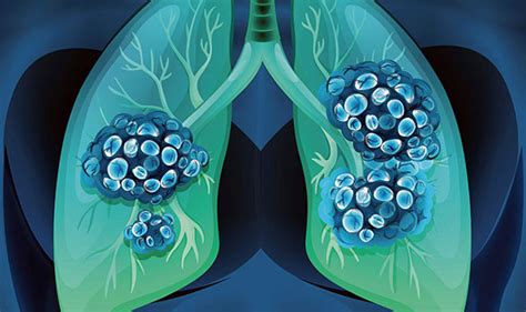 Small Cell Lung Cancer Vanderbilt University