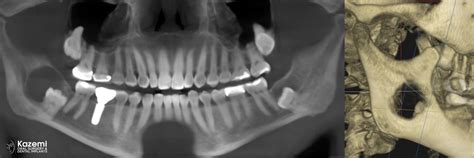 Mandibular Jaw Dentigerious Cyst Coronectomy Partial Extraction Therapy