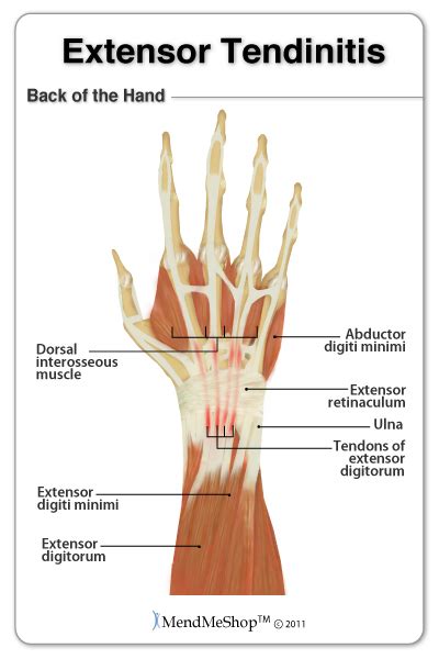 Elbow/forearm tendon ligament tear | health life media. Tendinitis Information and Treatments