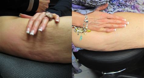 cellulite treatment before and after of actual dm patients