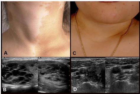 Clinical And Ultrasound Findings Of Thyroid Involvement In Fdmas