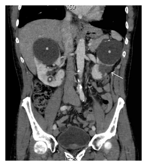Ct Of The Abdomen And Pelvis With Contrast Demonstrating A
