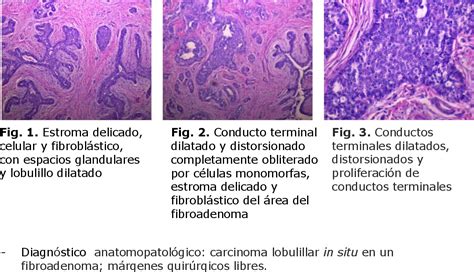 Pdf Carcinoma Lobulillar In Situ En Una Paciente Con Fibroadenoma Mamario Semantic Scholar