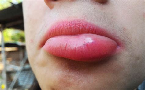 Swollen Lips 7 Causes 5 Home Remedies 3 Medical Treatments And Precau