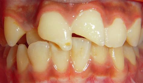 Treated Cases Direct Veneers Restore Dental Treatment Centre