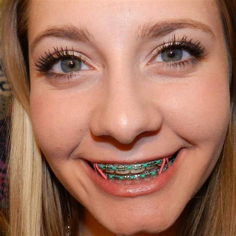 List Of What Is The Best Color To Use For Braces Ideas