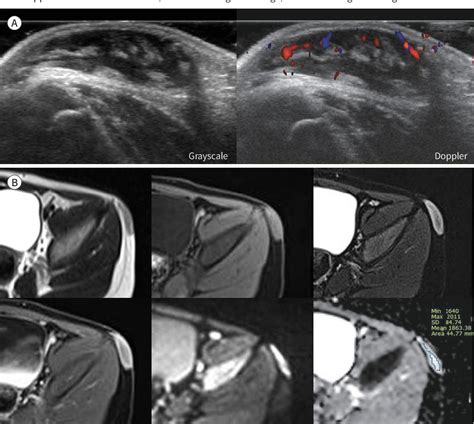 Figure 1 From Ultrasound And Mri Findings Of Giant Cell Fibroblastoma