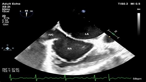 The Anatomy Of The Eustachian Valve—navigating The Implications For