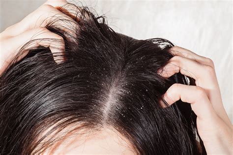 5 Homemade Dandruff Treatments that really works