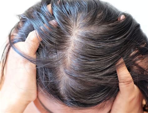 What Causes Oily Scalp And How To Treat It At Home