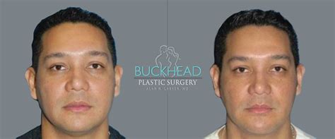 Chin Augmentation Buckhead Plastic Surgery Atlanta Ga