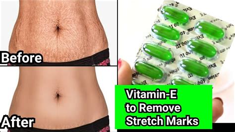 Remove Stretch Marks Completely From All Body Parts Easy Remedy Youtube