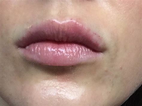 White Spots On Lips After Filler