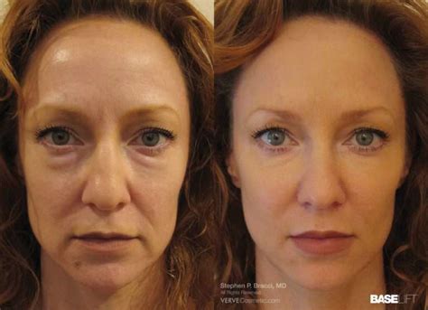 Facial And Cheek Sagging Causes And Treatments Verve Medical