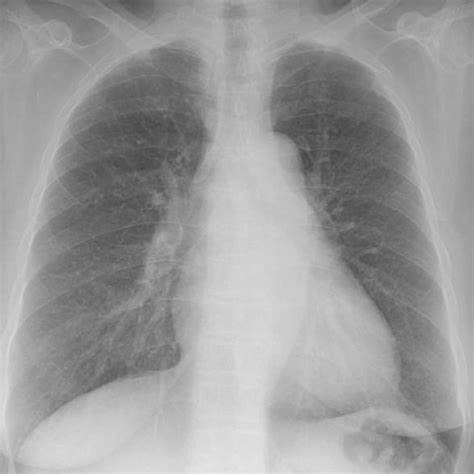 Chest Radiography On Admission Revealed Cardiomegaly And Increased