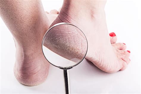 Gout Vs Cracked Heels Dermatology Surgery And Cosmetics Of Northeast Ohiodermatology Surgery