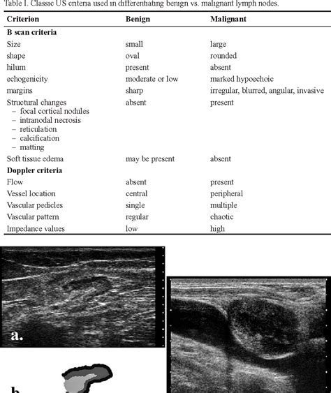 Table I From Ultrasonography Of Superficial Lymph Nodes Benign Vs
