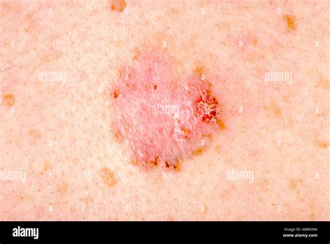 Basal Cell Carcinoma Bcc Stock Photo Alamy