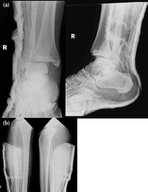 A A Short Oblique Fracture Of The Lateral Malleolus And Download