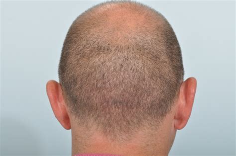 Hair Transplant Scar Removal Fue Hair Transplant Donor Scars After