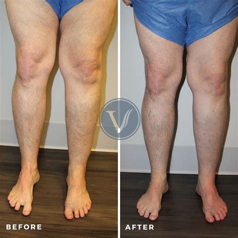 Treatment For Bulging Varicose Veins For 41yo Man