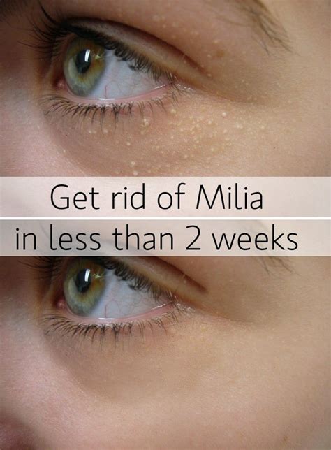 How To Remove Milia On Chest Howtoremo
