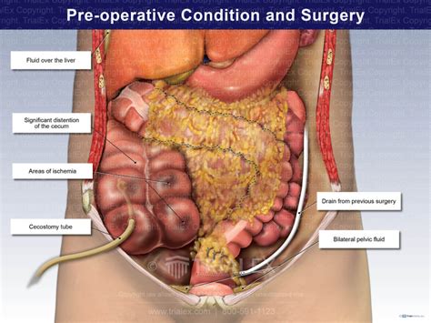 pre operative condition and surgery trialexhibits inc