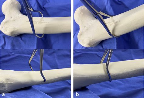 Surgical Outcomes Of Minimally Invasive Cerclage Clamping Technique