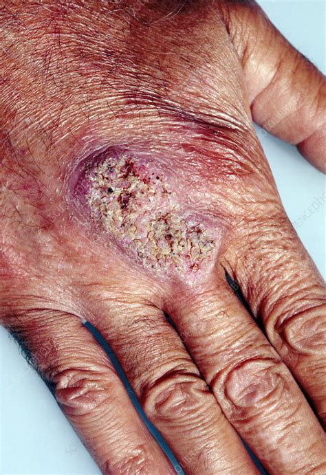 Fungal Skin Infection Stock Image M1200130 Science Photo Library