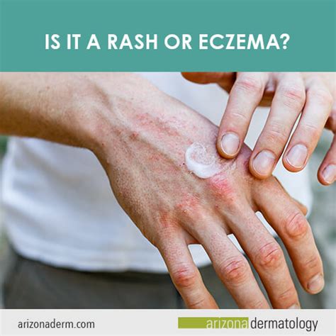 Is It A Rash Or Eczema