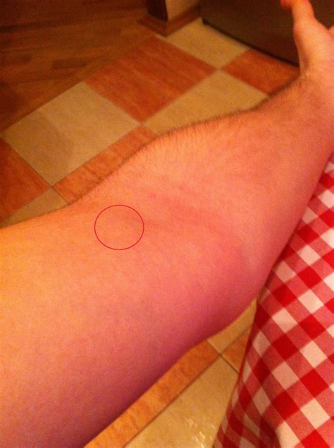 Последние твиты от upl (ukraine) (@upl_official). Уплотнение под кожей на руке - Вопрос хирургу - 03 Онлайн