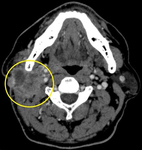 Ct Scan Showing The Mass Lesion In The Parotid Region With Extension