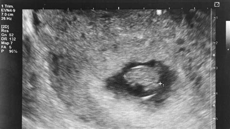 10 Weeks Pregnant Ultrasound Twins Twin Ultrasound At 6 Weeks