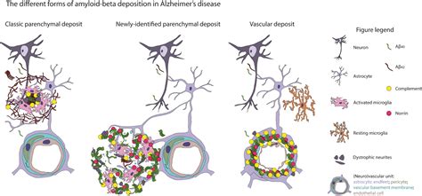 Newly Found Alzheimers Plaque Type Linked To Early Onset Disease The