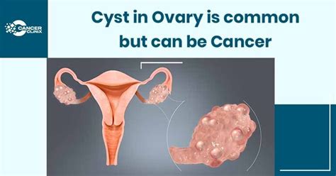 Laparoscopic Ovarian Cyst Removal Cancerclinix