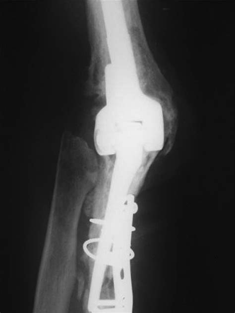 Total Elbow Arthroplasty After Previous Resection Of The Radial Head