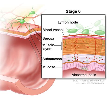Colon Cancer Stages Roswell Park Comprehensive Cancer Center Buffalo Ny
