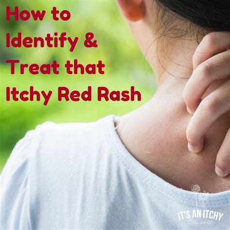 How To Identify And Treat That Itchy Red Rash Its An Itchy Little World