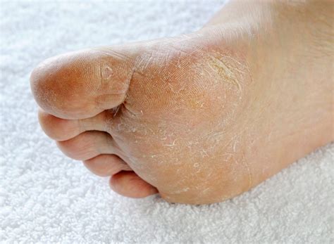 Athletes Foot Treatment Foot Fungus Us Dermatology Partners