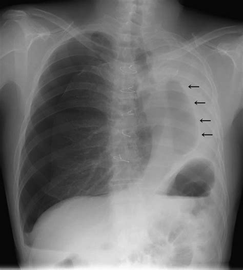 Chest Roentgenogram On Admission Shows The Remarkable Mediastinal Shift