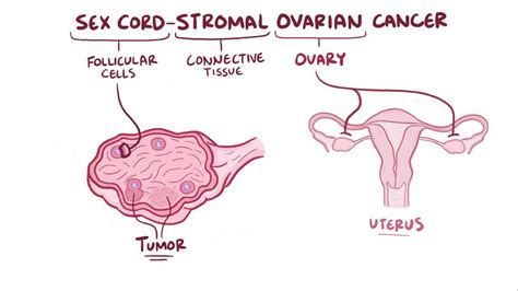 Sex Cord Gonadal Stromal Tumor Video And Anatomy Osmosis