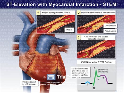 St Elevation Myocardial Infarction Stemi Case Study Y