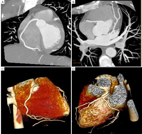 Cardiac Ct Imaging In Coronary Artery Disease Current Status And