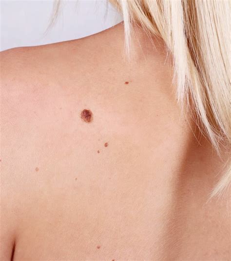Brown Spots On The Skin Advanced Dermatology