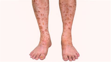 Rash On Legs Causes And Treatment