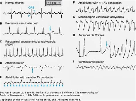It changes with physical activity, fear, emotional reactions. Irregular Heartbeat - Causes, Symptoms, Treatment, What is ...